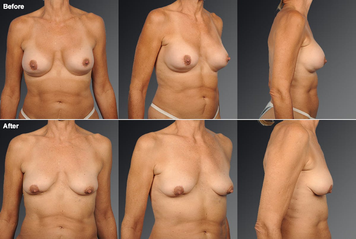 Explantation Before & After Gallery - Patient 134859576 - Image 1