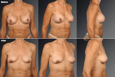 Explantation Before & After Gallery - Patient 134859576 - Image 1