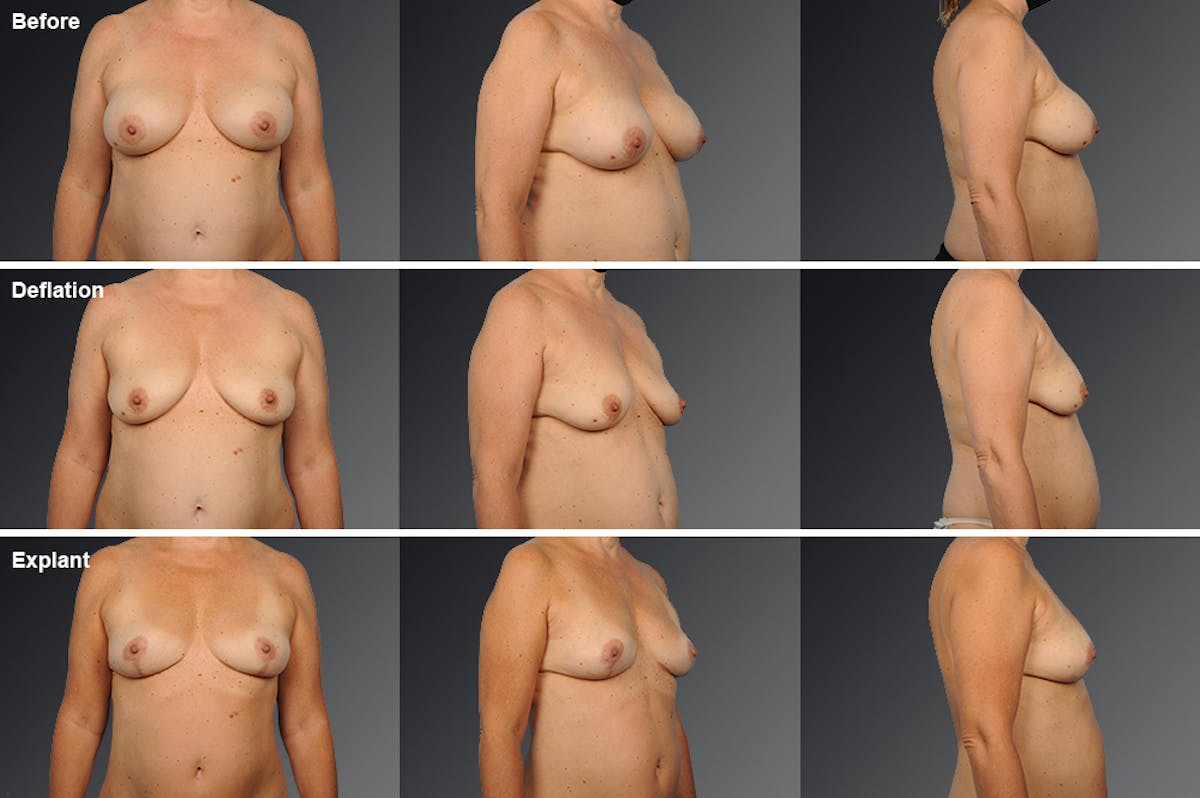 Explantation Before & After Gallery - Patient 134859588 - Image 1