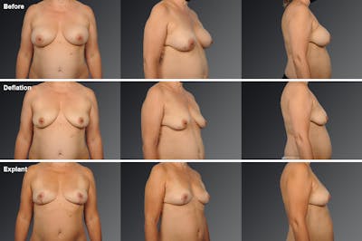 Explantation Before & After Gallery - Patient 134859588 - Image 1