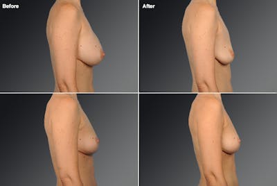 Explantation Before & After Gallery - Patient 134859613 - Image 1