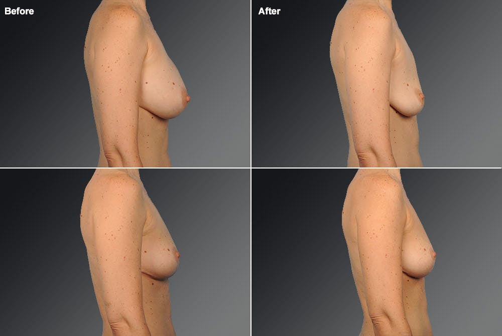 Explantation Before & After Gallery - Patient 134859613 - Image 1
