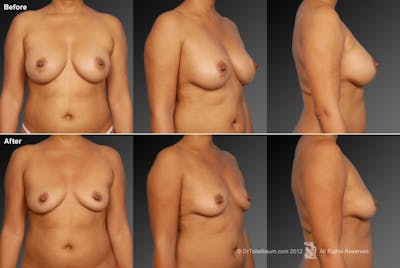 Explantation Before & After Gallery - Patient 134859632 - Image 1