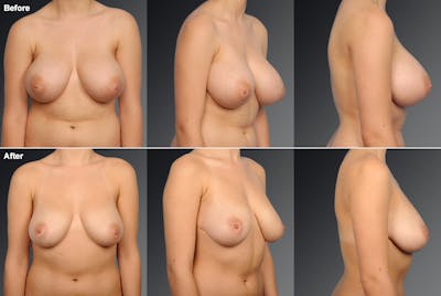 Scarless Before & After Gallery - Patient 134859665 - Image 1