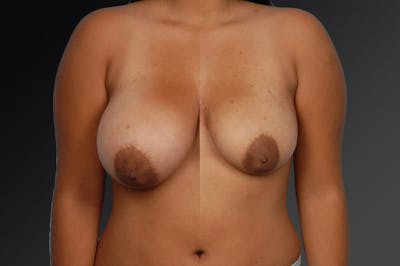 Scarless Before & After Gallery - Patient 134859684 - Image 1