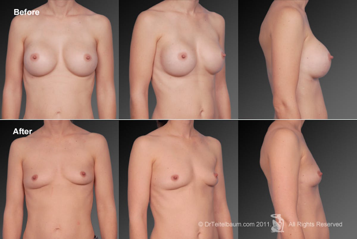 Explantation Before & After Gallery - Patient 134859687 - Image 1