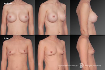 Explantation Before & After Gallery - Patient 134859687 - Image 1