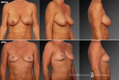 Standard Before & After Gallery - Patient 134859703 - Image 1