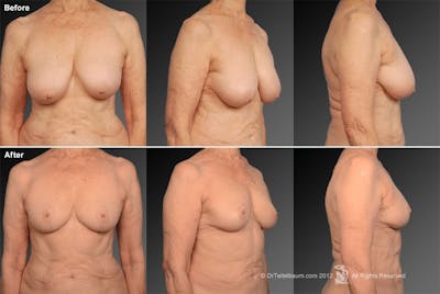 Standard Before & After Gallery - Patient 134859714 - Image 1