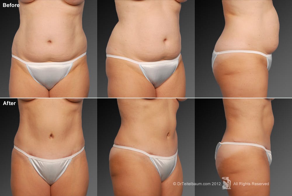 Mini Tummy Tuck Before & After Gallery - Patient 134859745 - Image 1