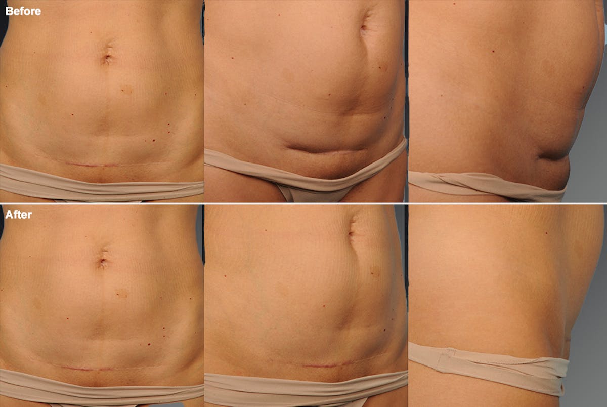 Cesarean Section Before & After Gallery - Patient 134862349 - Image 1