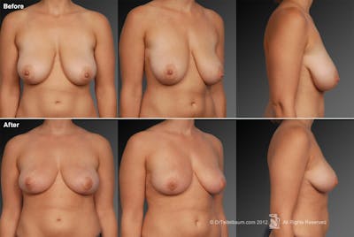Standard Before & After Gallery - Patient 134862384 - Image 1