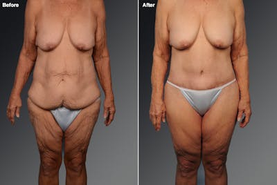 Weight Loss Bariatric Before & After Gallery - Patient 134862393 - Image 1