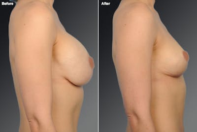 Explantation Before & After Gallery - Patient 134862427 - Image 1