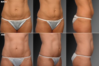Mini Tummy Tuck Before & After Gallery - Patient 134862444 - Image 1