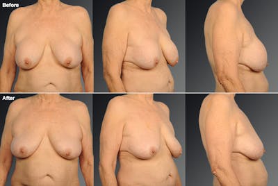 Explantation Before & After Gallery - Patient 134862465 - Image 1