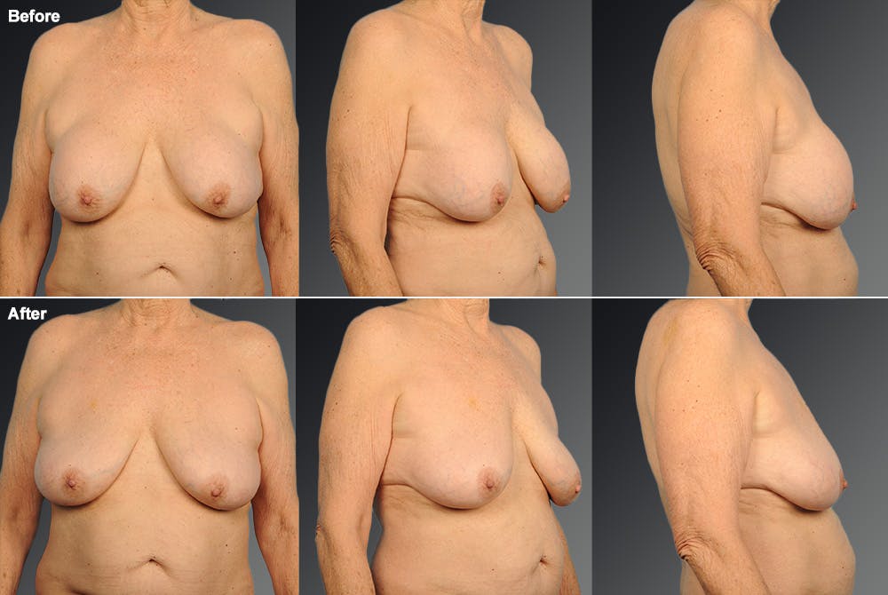 Explantation Before & After Gallery - Patient 134862465 - Image 1