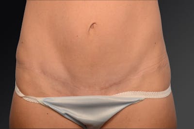 Mini Tummy Tuck Before & After Gallery - Patient 134862499 - Image 1