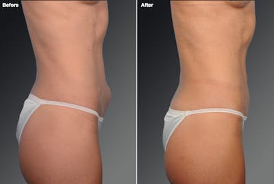 Mini Tummy Tuck Before & After Gallery - Patient 134862596 - Image 1