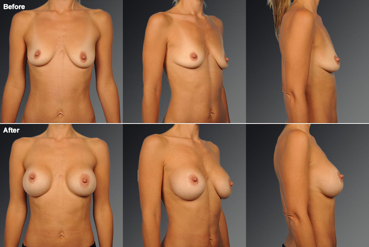 Breast Augmentation Before & After Gallery - Patient 234364 - Image 1