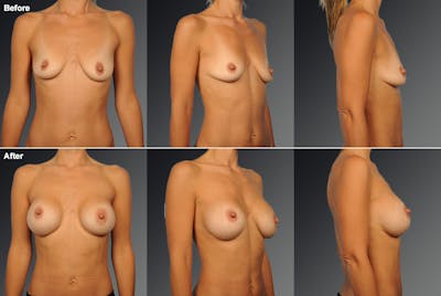 Breast Augmentation Before & After Gallery - Patient 234364 - Image 1