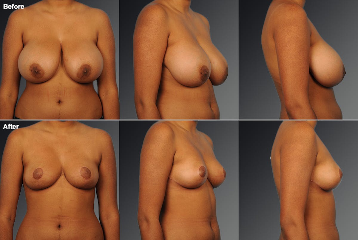 Standard Before & After Gallery - Patient 233715 - Image 1