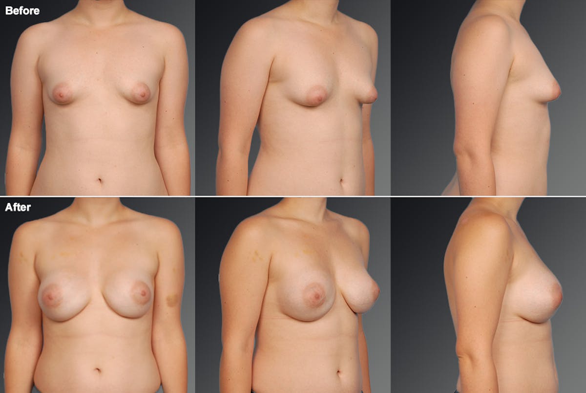 Tuberous Before & After Gallery - Patient 246915 - Image 1