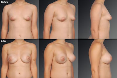 Tuberous Before & After Gallery - Patient 246915 - Image 1