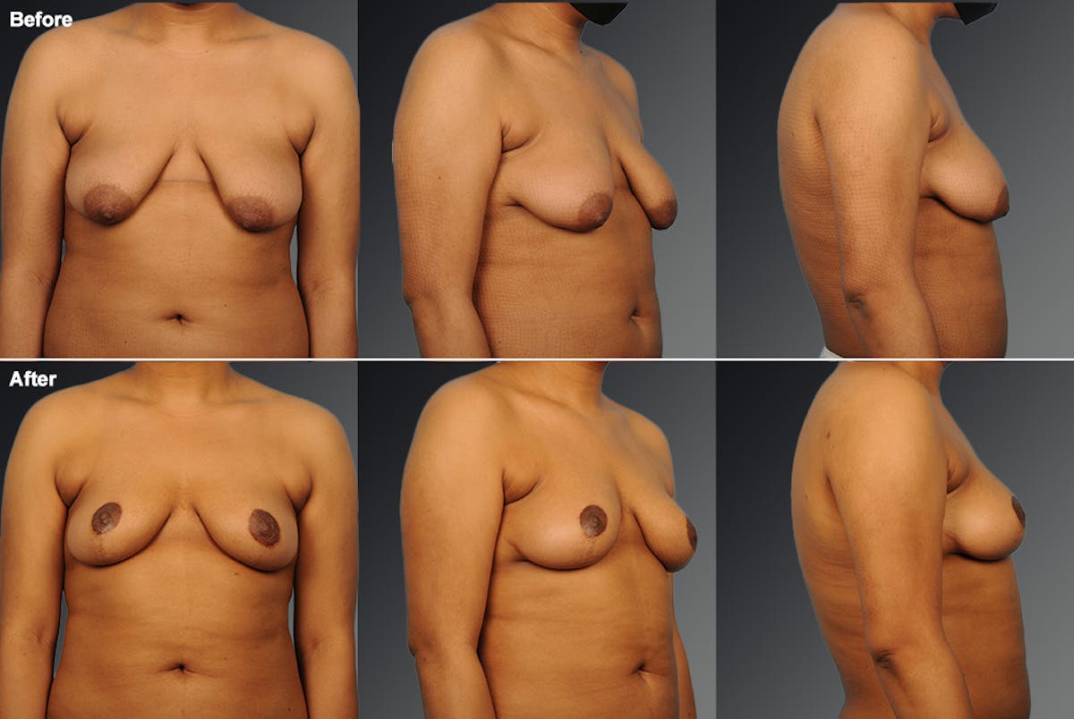 Breast Lift (Mastopexy) Before & After Gallery - Patient 129876 - Image 1