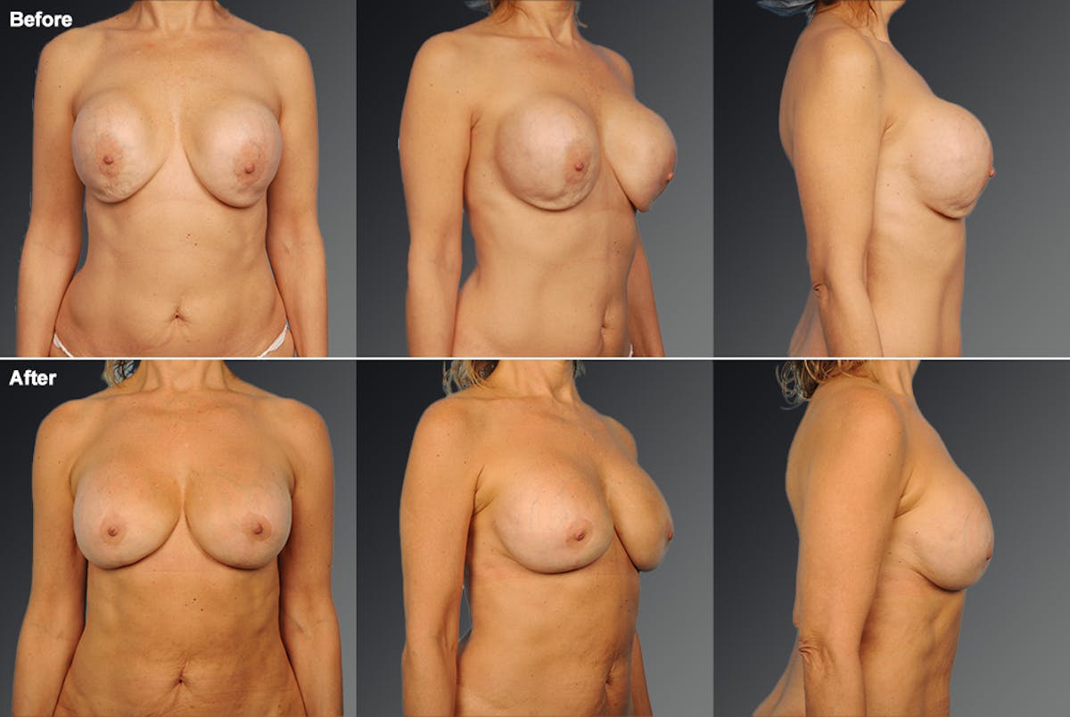 Capsular Contracture Before & After Gallery - Patient 179574 - Image 1