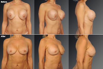 Capsular Contracture Before & After Gallery - Patient 179574 - Image 1
