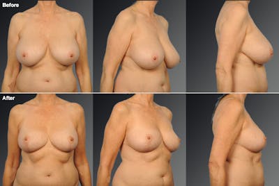 Standard Before & After Gallery - Patient 690161 - Image 1