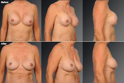 Capsular Contracture Before & After Gallery - Patient 155667 - Image 1