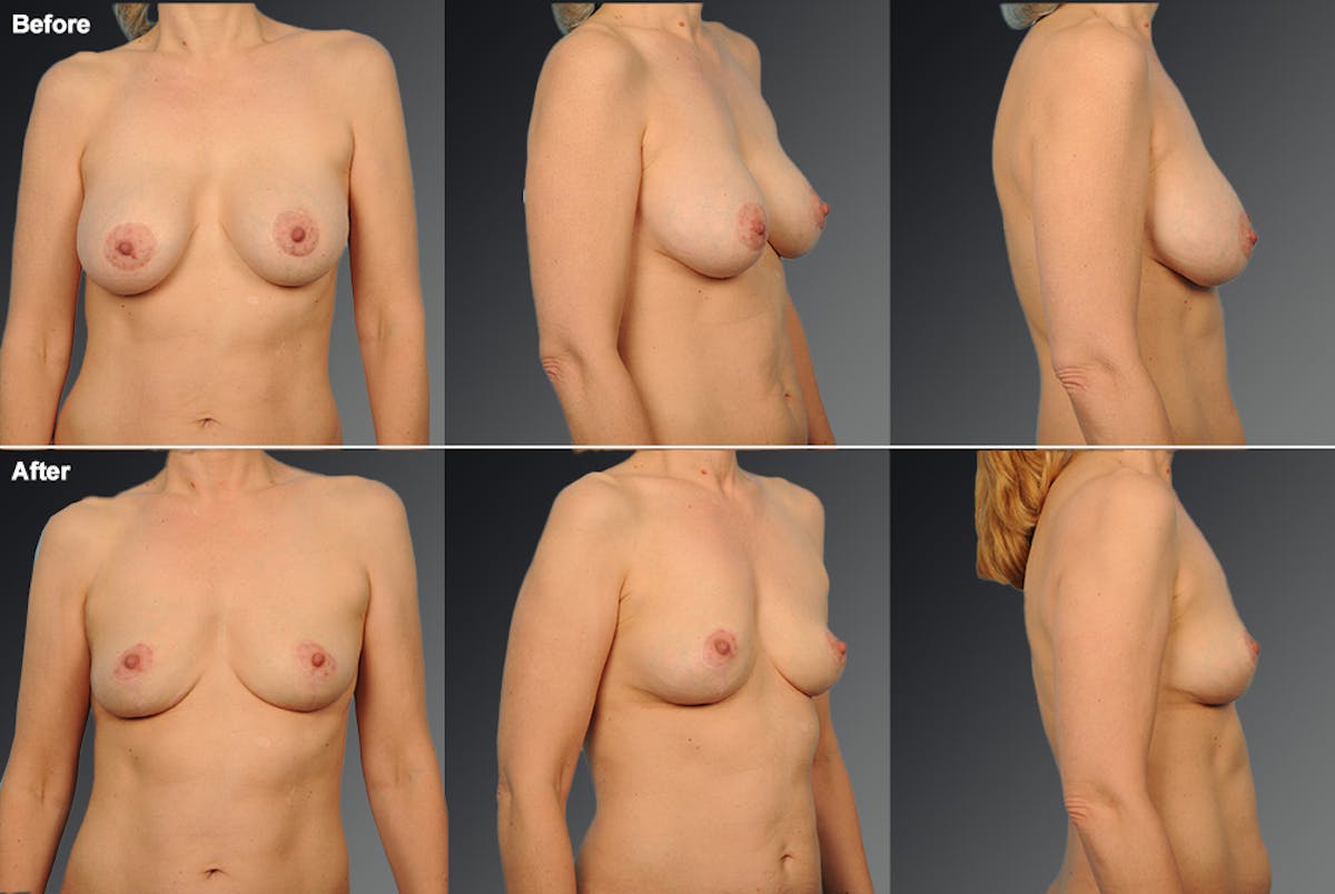 Explantation Before & After Gallery - Patient 159774 - Image 1