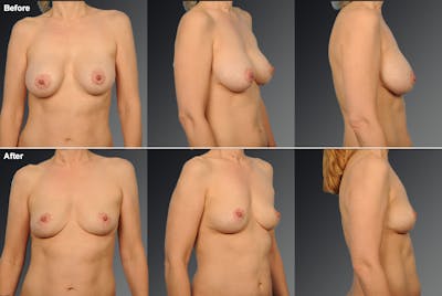 Explantation Before & After Gallery - Patient 159774 - Image 1