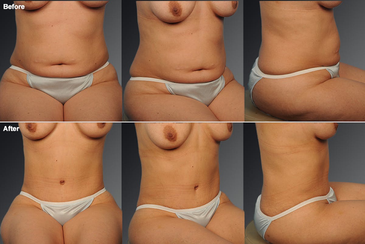 Tummy Tuck Before & After Gallery - Patient 418335 - Image 1