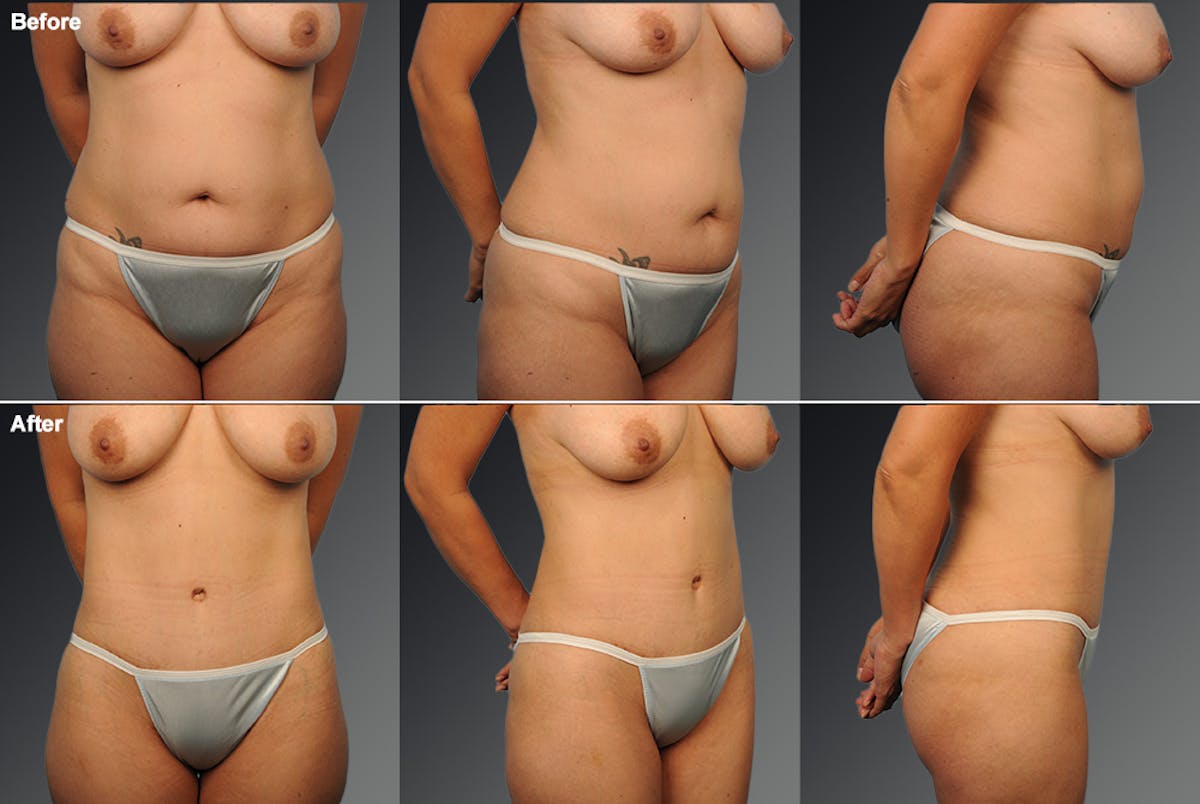 Tummy Tuck Before & After Gallery - Patient 112407 - Image 1