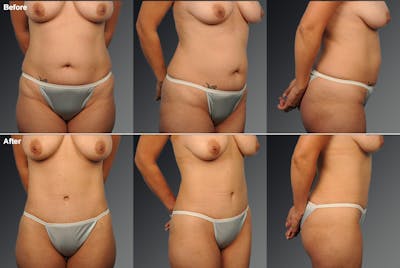 Tummy Tuck Before & After Gallery - Patient 112407 - Image 1
