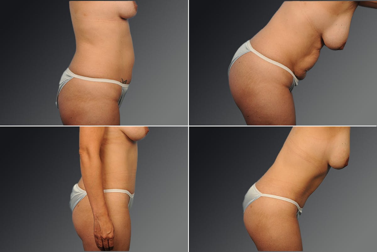 Tummy Tuck Before & After Gallery - Patient 397693 - Image 1