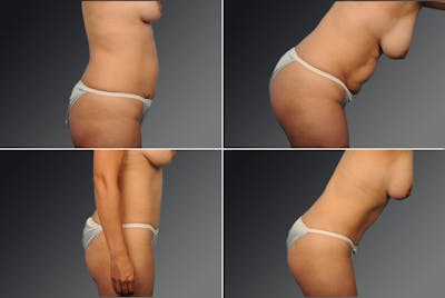 Tummy Tuck Before & After Gallery - Patient 397693 - Image 1