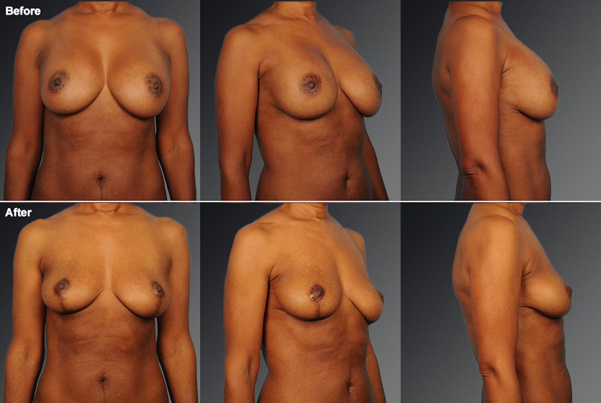Explantation Before & After Gallery - Patient 545274 - Image 1