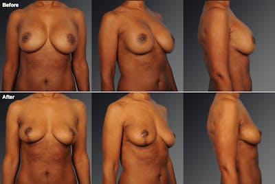 Explantation Before & After Gallery - Patient 545274 - Image 1