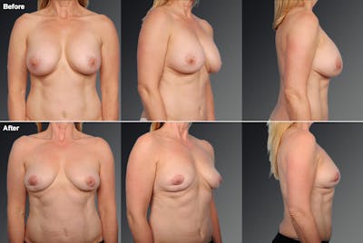 Explantation Before & After Gallery - Patient 163433 - Image 1