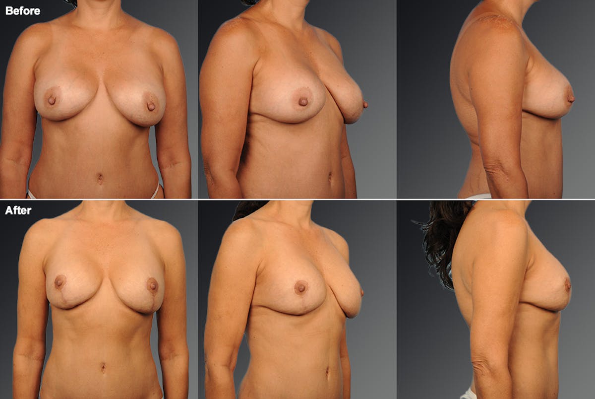 Breast Implant Revision Before & After Gallery - Patient 565928 - Image 1