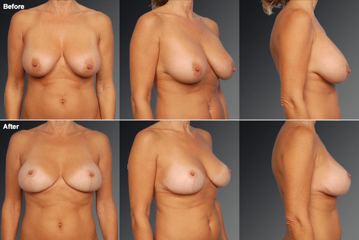 Breast Implant Revision Before & After Gallery - Patient 425682 - Image 1