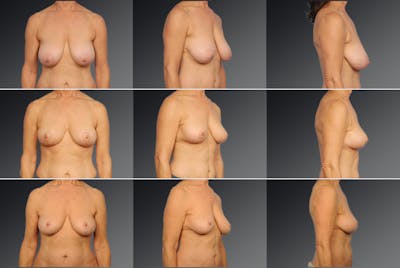 Standard Before & After Gallery - Patient 401659 - Image 1