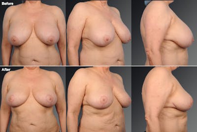 Breast Lift (Mastopexy) Before & After Gallery - Patient 397974 - Image 1