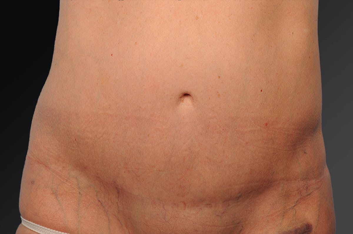 Tummy Tuck Before & After Gallery - Patient 238288 - Image 1