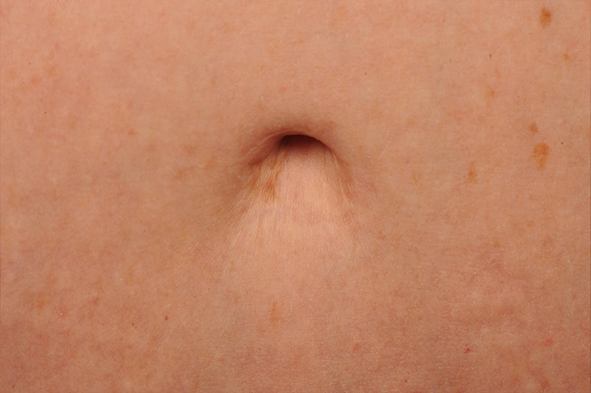Tummy Tuck Before & After Gallery - Patient 411440 - Image 1
