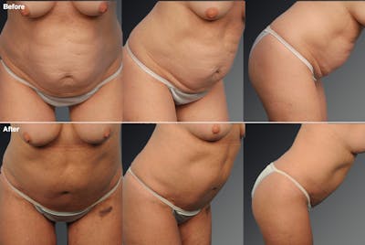 Tummy Tuck Before & After Gallery - Patient 299496 - Image 1